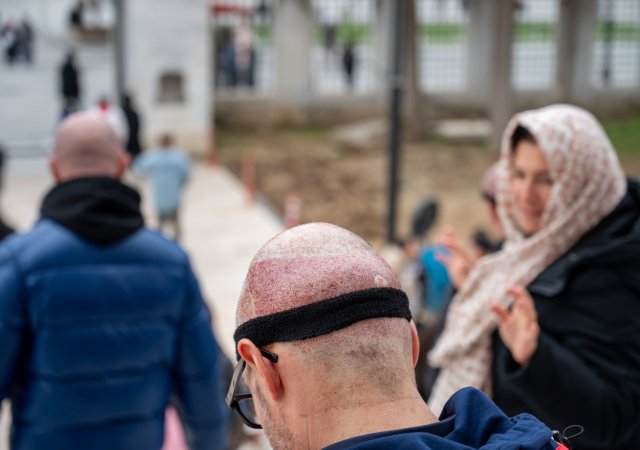 Transplantace vlasů Istanbul