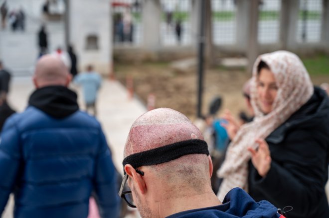 Transplantace vlasů Istanbul