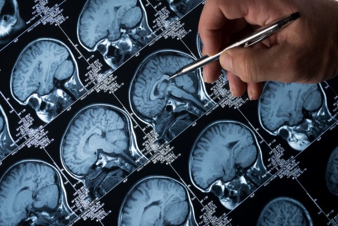 Biohacking: Cukrovka ovlivňuje mozek a nástup Alzheimerovy choroby